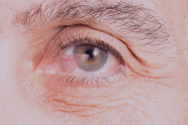 Pterjium (Göz Eti) Nədir?