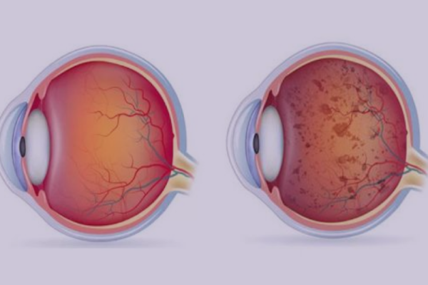 Retinitis Pigmentosa: Gecə Korluğu Haqqında Bilməli Olduqlarımız